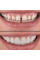 Накладка на зубы tooth cover perfect-smile-veneers винир
