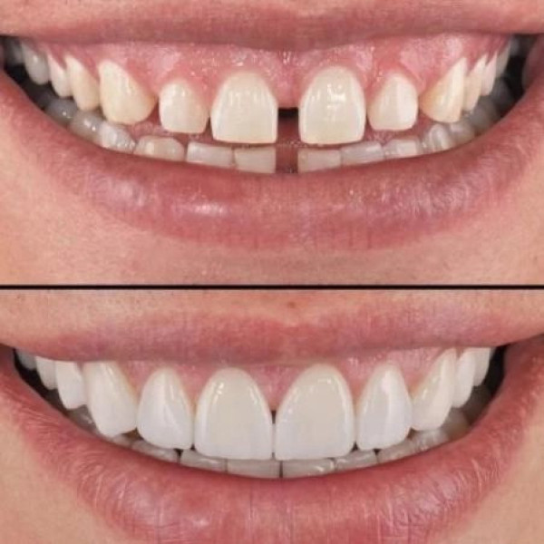 Накладка на зубы tooth cover perfect-smile-veneers винир